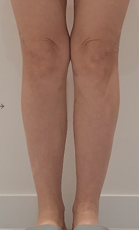 Calf contour · filler after treatment at HOMMAGE Clinic