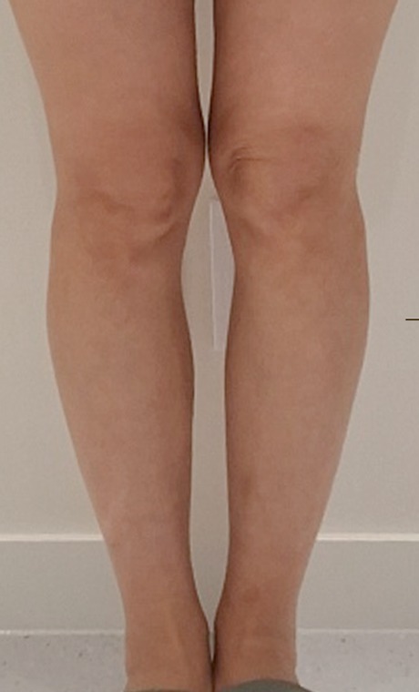 Calf contour · filler before treatment at HOMMAGE Clinic