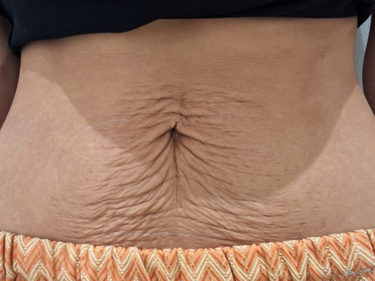 Renuvion · abdomen before treatment at HOMMAGE Clinic